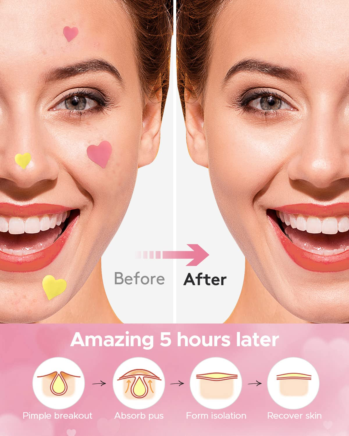 3 in 1 Acne Patch for Face, 7 Sizes 368 Patches Hydrocolloid Acne Patches for Chin, Forehead, Nose, 16 XL Pimple Patches Large for Body, Heart-Shaped Acne Cover Zit Patches Acne Dots Sticker