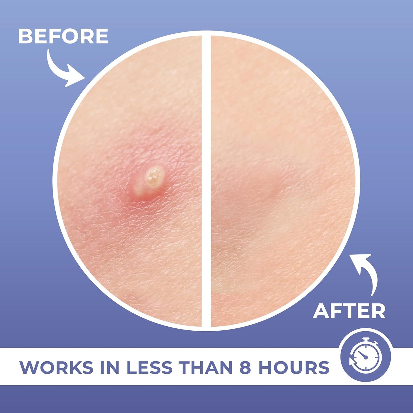 Patchrx Salicylic Pimple Patches (120 Pack), Salicylic Acid Acne Patches with Tea Tree Oil - Zit Patch and Pimple Stickers for Face for Skin Care - Salicylic Acid Acne Dots (Packaging May Vary)