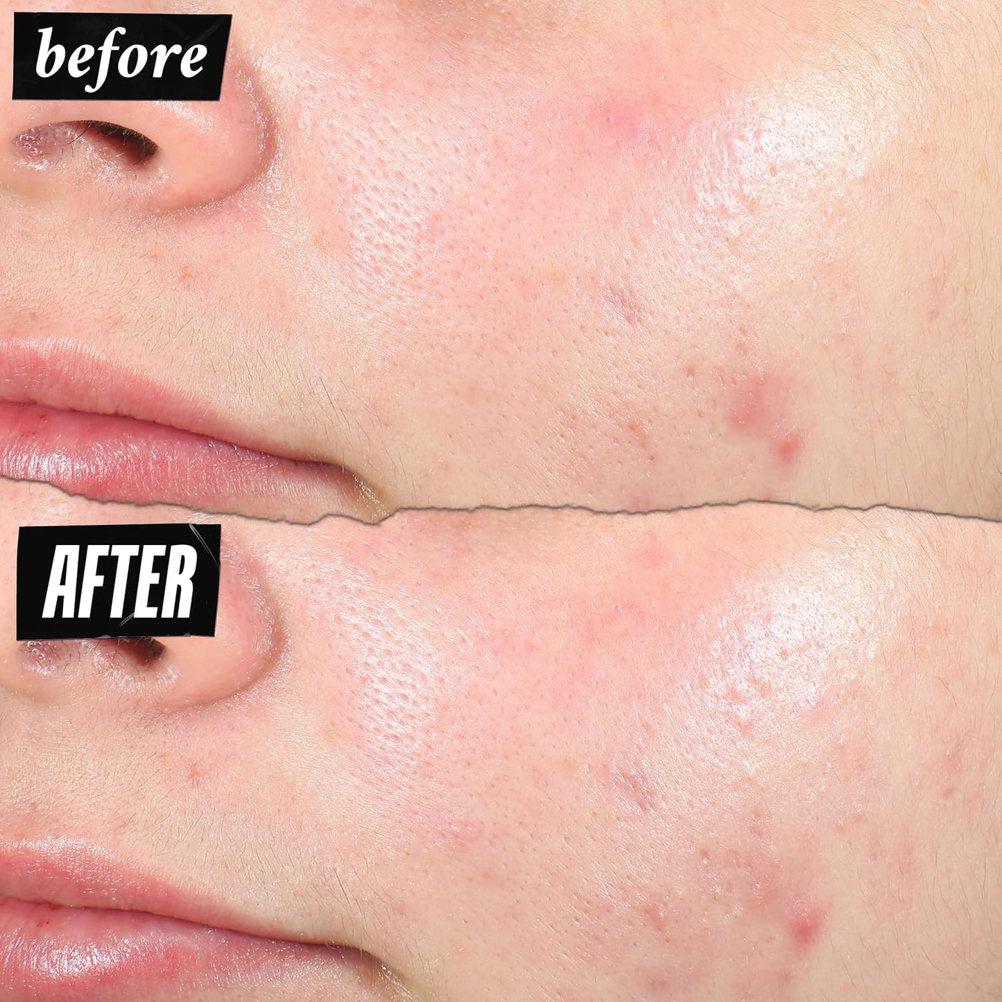 Kiehl'S Truly Targeted Acne-Clearing Pimple Patch with 2% Salicylic Acid, Invisible Liquid Spot Treatment, 4% Niacinamide Fades Post-Acne Marks, 0.2% Licorice Root Soothes Redness - 0.5 Fl Oz