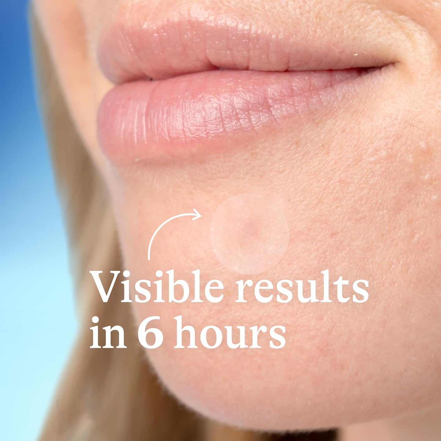 Acne Patches, Pimple Patches for Acne Prone Skin, Formulated with Salicylic Acid and Centella, Fast Triple Action Power Patch for Day & Night, Dermatologist Tested, 36 Count