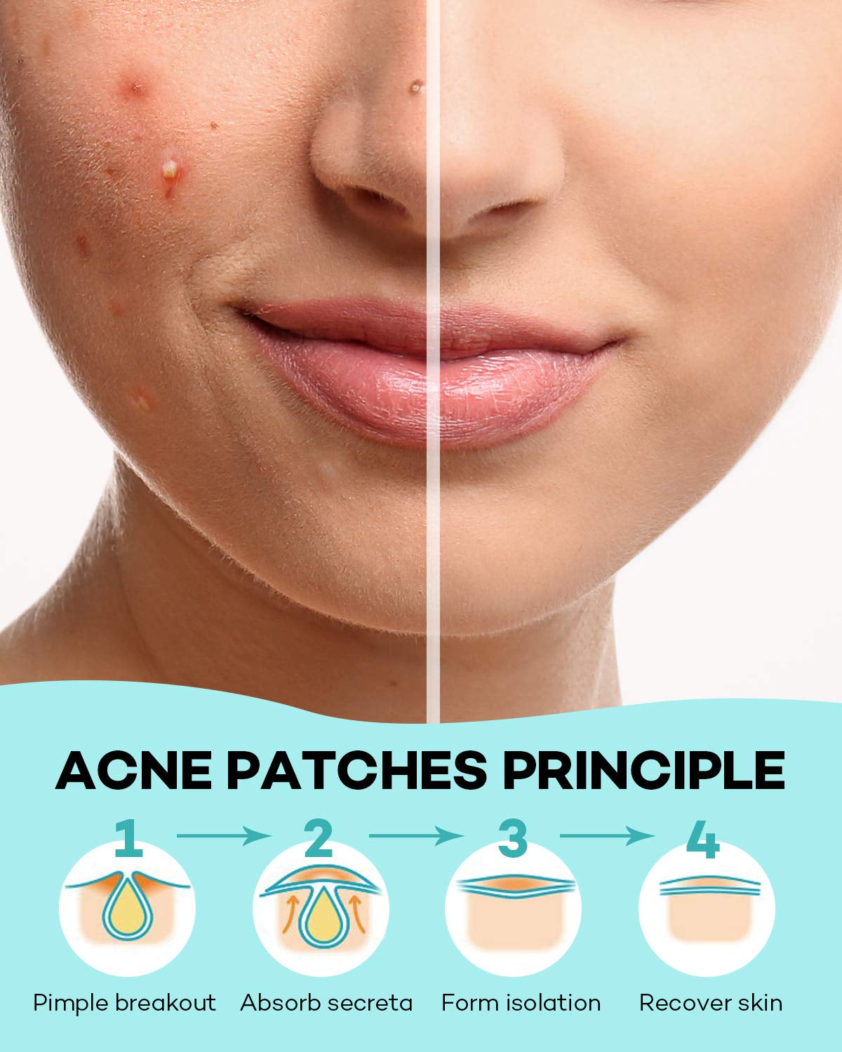 Acne Patch Pimple Patch, 4 Sizes 140 Patches Acne Absorbing Cover Patch, Hydrocolloid Invisible Acne Patches for Face Zit Patch Acne Dots Tea Tree, Calendula Oil