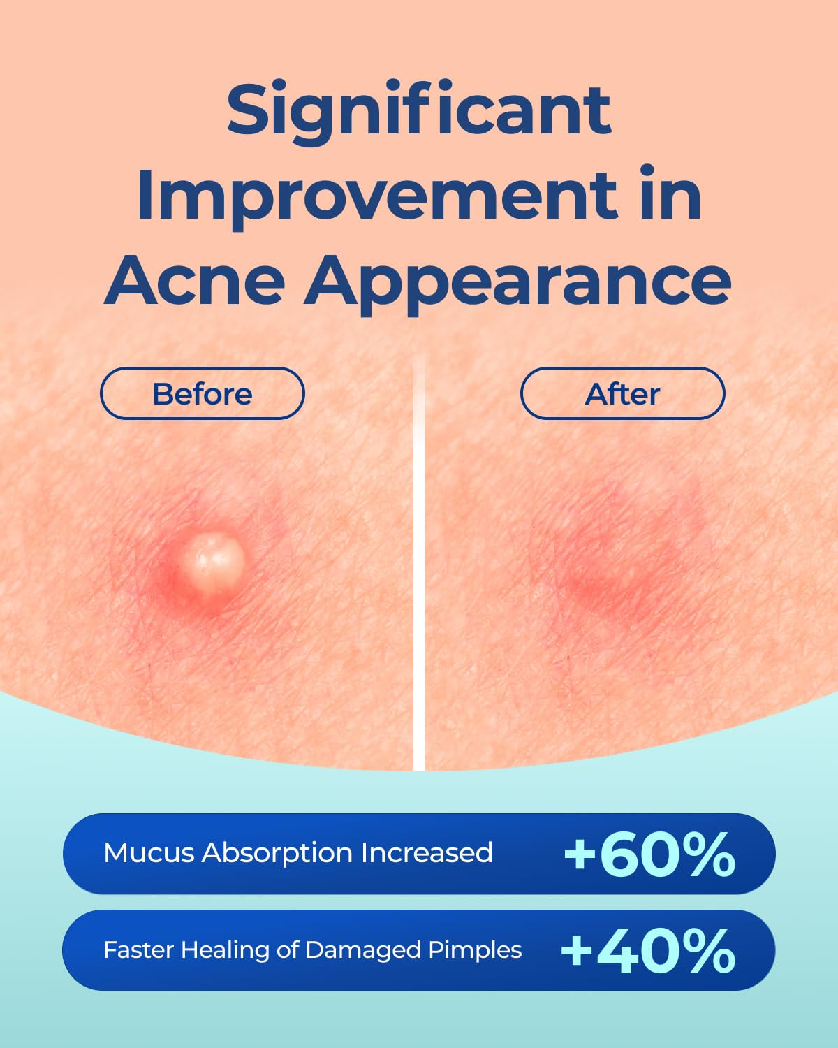 Pimple Patches for Face Acne: 0.1Mm Ultra-Thin Hydrocolloid Zit Stickers with Tea Tree Oil - 44 Invisible Dots, 2 Sizes (Whiteheads/Sensitive Skin)