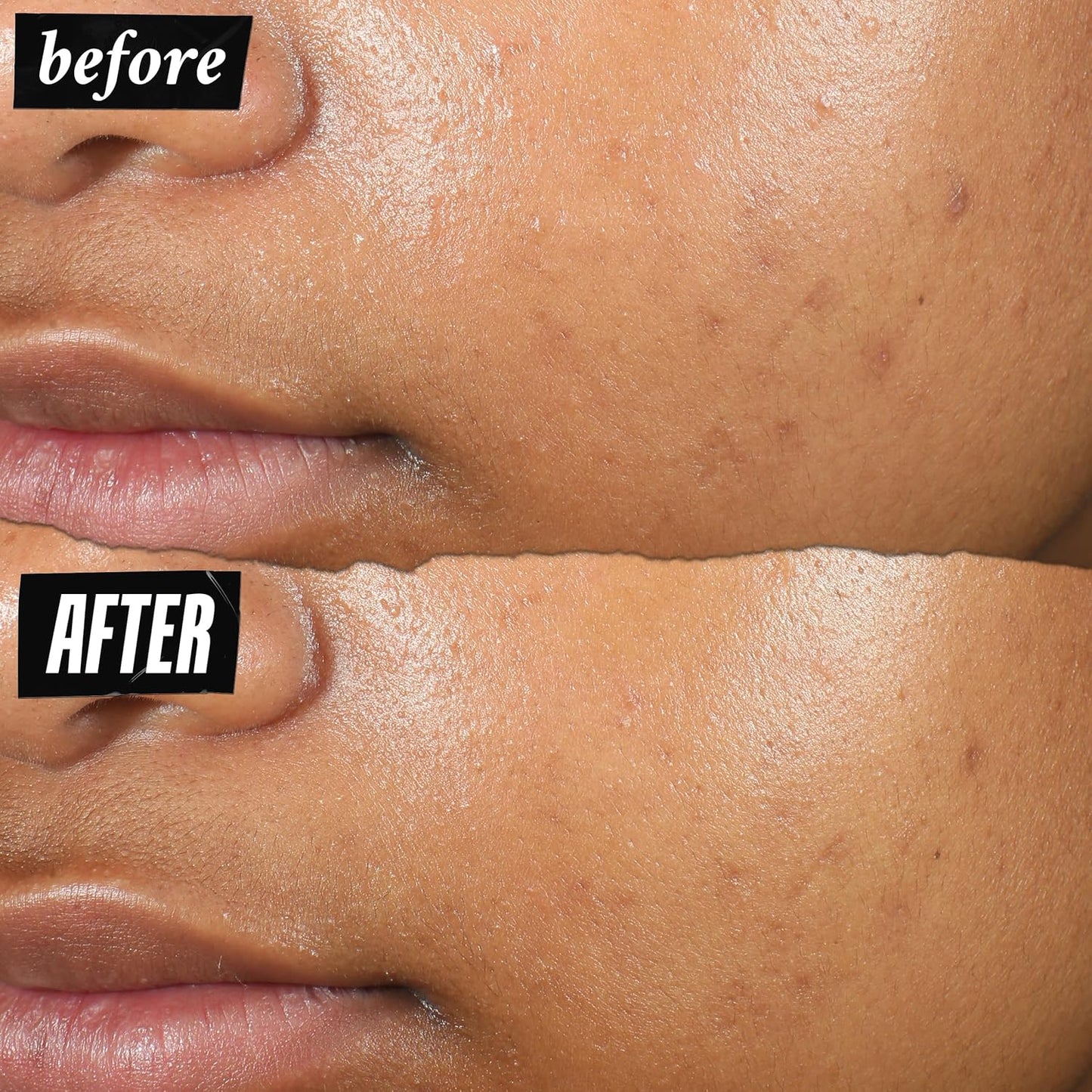 Kiehl'S Truly Targeted Acne-Clearing Pimple Patch with 2% Salicylic Acid, Invisible Liquid Spot Treatment, 4% Niacinamide Fades Post-Acne Marks, 0.2% Licorice Root Soothes Redness - 0.5 Fl Oz