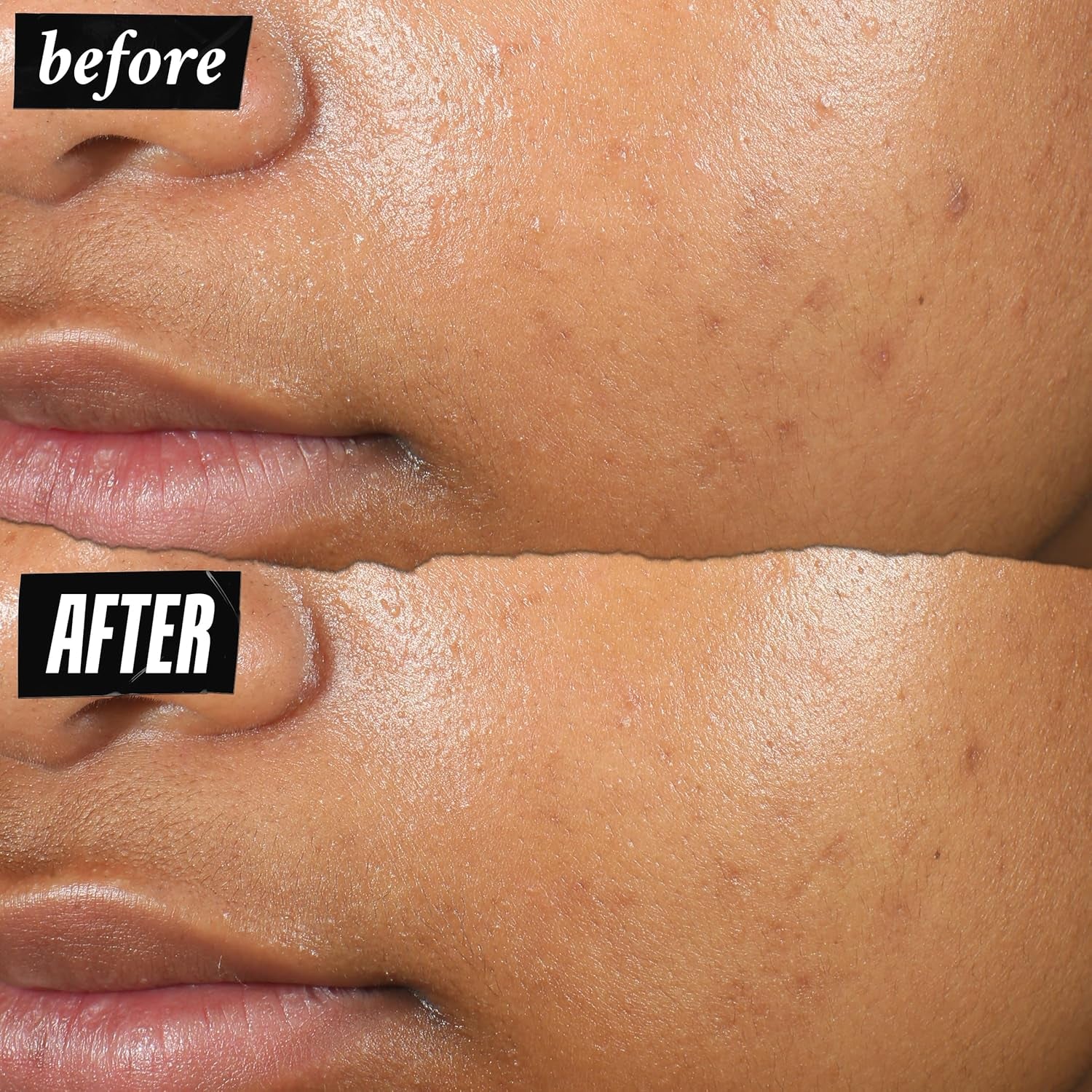 Kiehl'S Truly Targeted Acne-Clearing Pimple Patch with 2% Salicylic Acid, Invisible Liquid Spot Treatment, 4% Niacinamide Fades Post-Acne Marks, 0.2% Licorice Root Soothes Redness - 0.5 Fl Oz