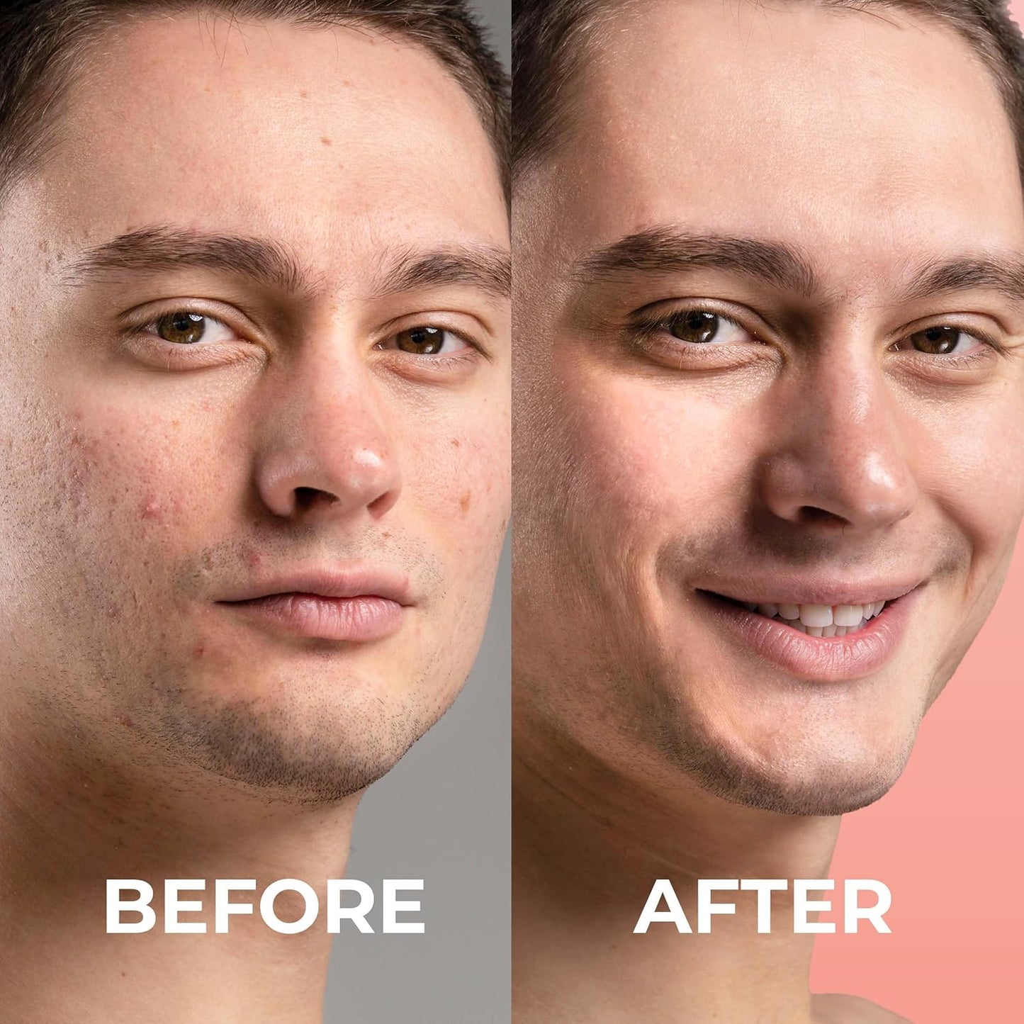 Micro Needle Pimple Patch (18 Pack) - Hydrocolloid Micropoint Pimple Patch for Acne & Cystic Pimples, Eliminate Pimples Overnight, Microdart Pimple Patch, Micro Dart Pimple Patches