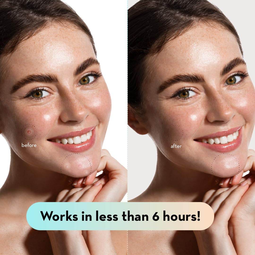 Korean Pimple Patches for Face (132 Dots) - Hydrocolloid Acne Patches with Tea Tree Oil - Invisible Zit Stickers - Dermatologist Tested - Korean Skin Care