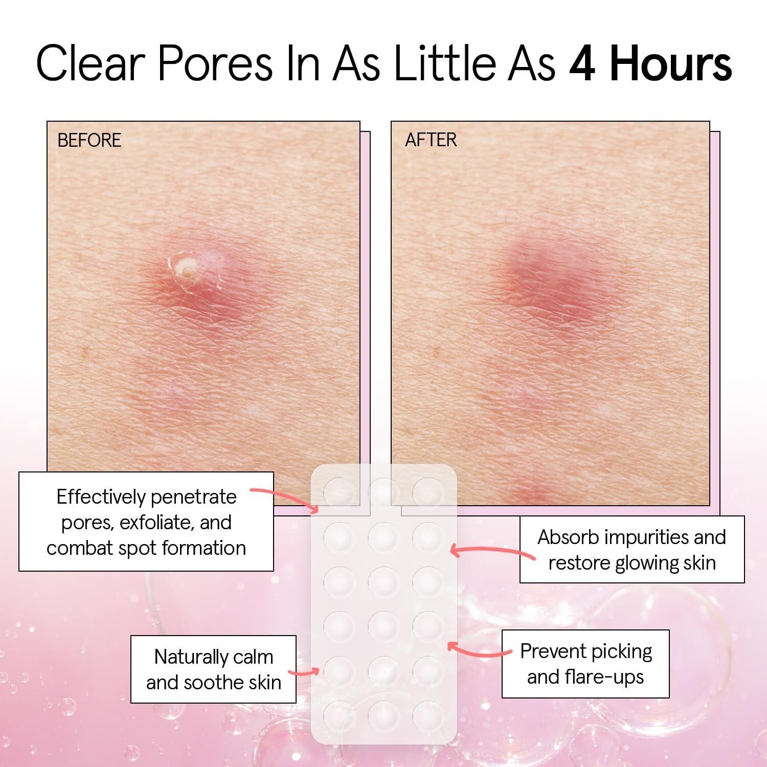 Pimple Patches for Face - Fast Acting Hydrocolloid Acne Patch That Absorb Gunk, Flatten Breakouts - Zit Stickers for Clear Skin - Dermatologist-Tested, Vegan (Invisible, 36 Count)