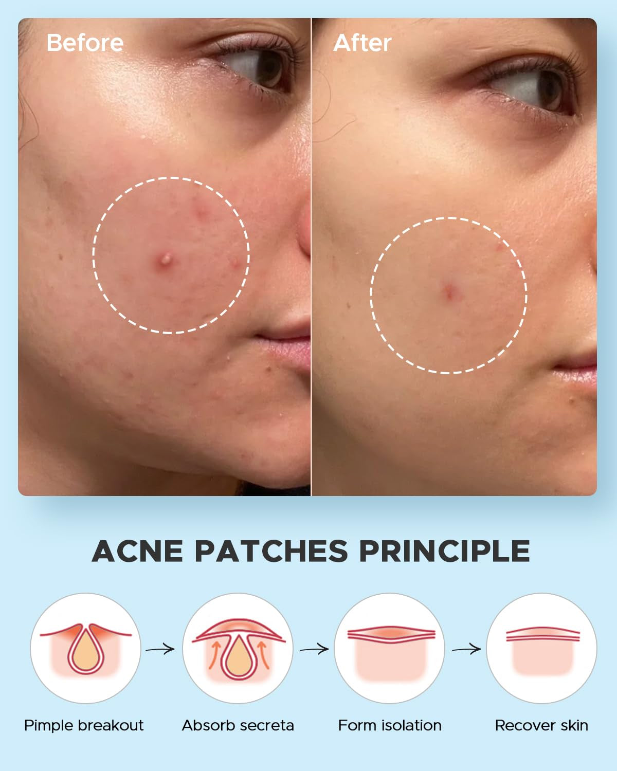 Acne Pimple Patches- Day and Night 4 Sizes 180 Dots Thin & Thick Hydrocolloid Patches with Witch Hazel, Tea Tree & Calendula Oil, Extra Adhesion for Face Zit Patch Dots