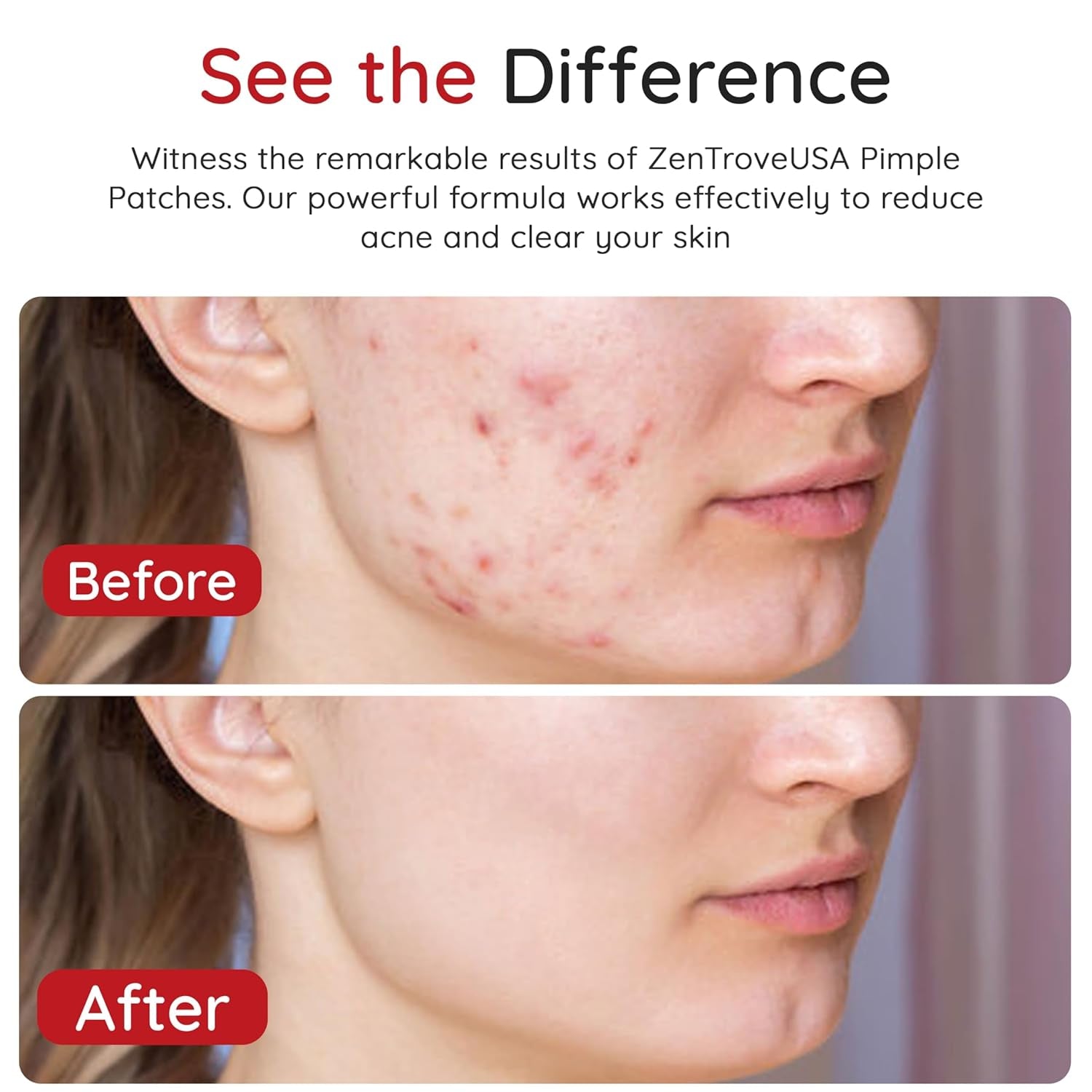 450 Pimple Patches for Face, 4 Size Acne Patches, Hydrocolloid Patches for Covering Zits and Blemishes, Spot Stickers with Salicylic Acid, Glycolic Acid, Tea Tree Oil and Calendula Oil