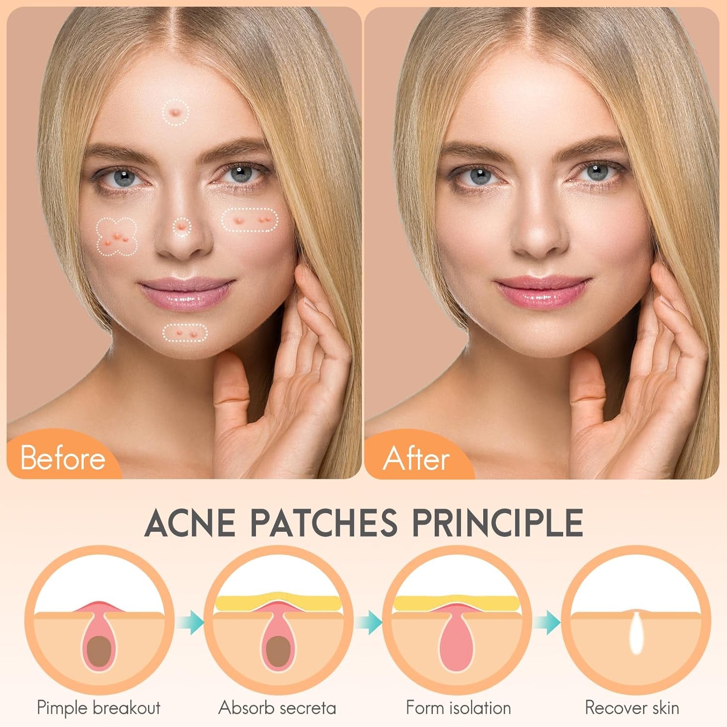 Acne Hydrocolloid Patches, 5 Sizes and 4 Shapes with 186Pcs, the Innovative Size L Suitable Face, Body, Nose, Pimple, Acne Blemishes, with Salicylic Acid, Tea Tree Oil,Centella Asiatica