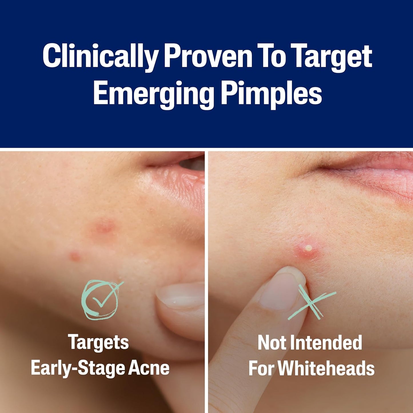 Acne Patches, Pimple Patches for Sensitive Skin, Formulated with Salicylic Acid, CICA, and Heartleaf Extract for Emerging Pimples, Visible Results in 6 Hours, 24 Count