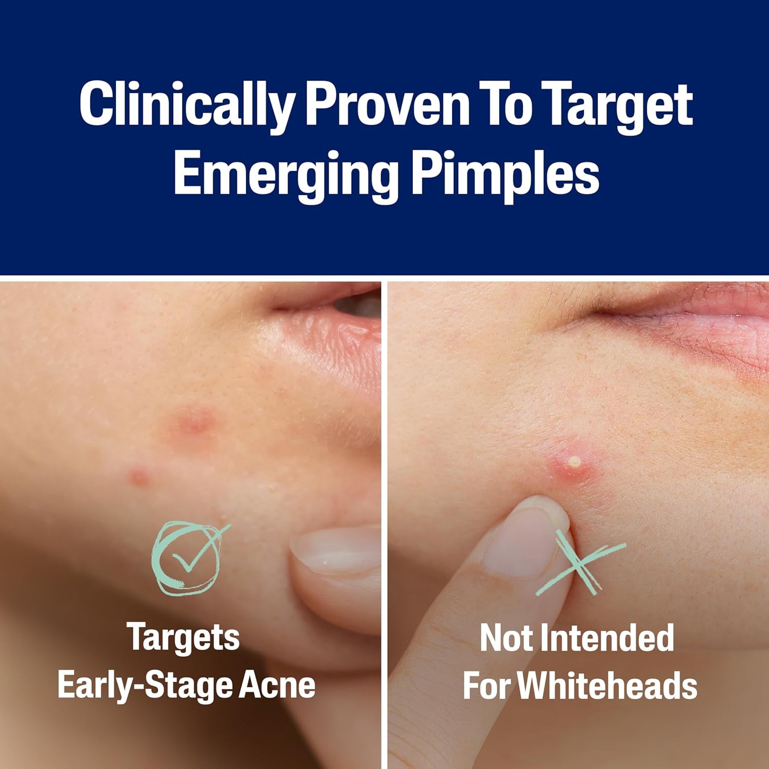 Acne Patches, Pimple Patches for Sensitive Skin, Formulated with Salicylic Acid, CICA, and Heartleaf Extract for Emerging Pimples, Visible Results in 6 Hours, 24 Count